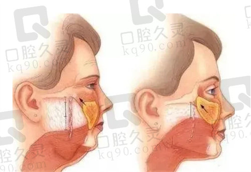 侯焯森索玛BTR抗衰提升