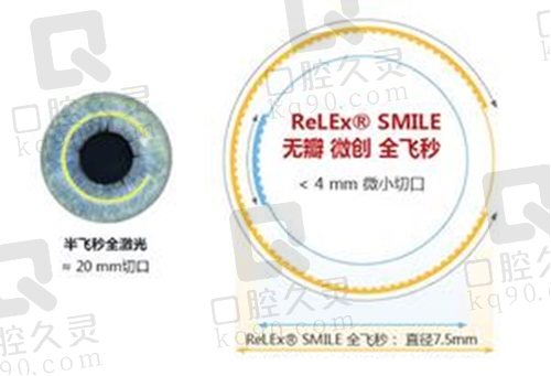 上海新视界眼科医院全飞秒激光近视手术