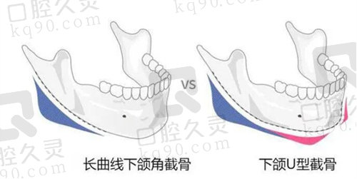 北京联合丽格下颌角截骨