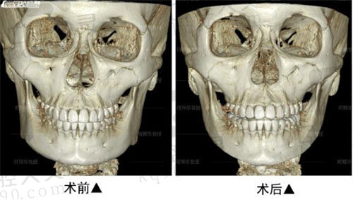 北京联合丽格下颌角术后