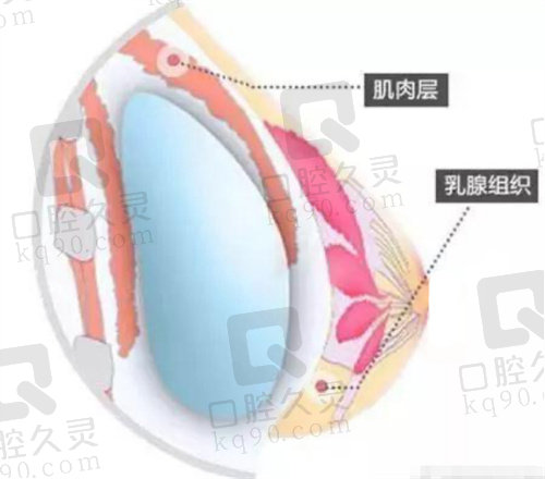 韩国欧佩拉整形外科双平面隆胸