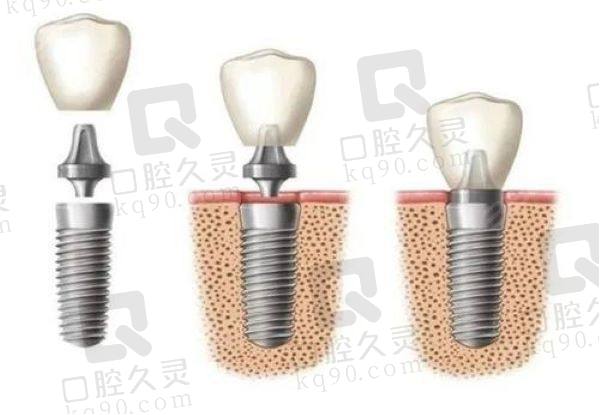 太原鼎植口腔医院奥齿泰半口种植牙价格