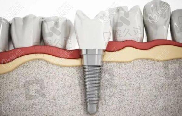 太原鼎植口腔医院奥齿泰半口种植牙怎么样