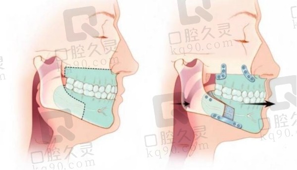 正畸正颌联合治疗流程