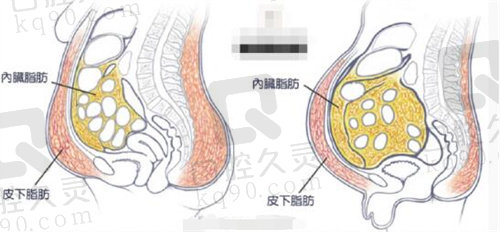 北京纯脂冯斌医生腰腹吸脂过程