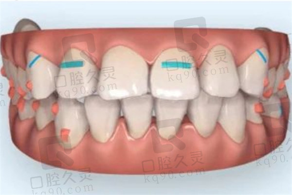 广州德伦口腔医院正畸设计