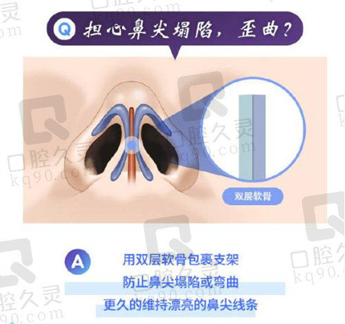 韩国TS整形外科双层软骨隆鼻