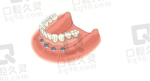 福州维乐口腔半口种植牙
