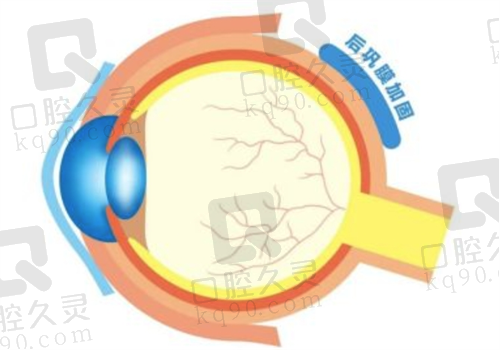 北京熙仁眼科医院做后巩膜加固术