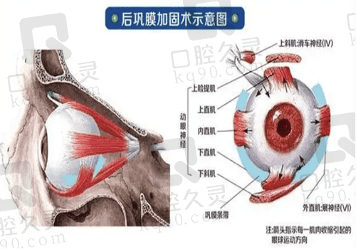 北京熙仁眼科医院做后巩膜加固术