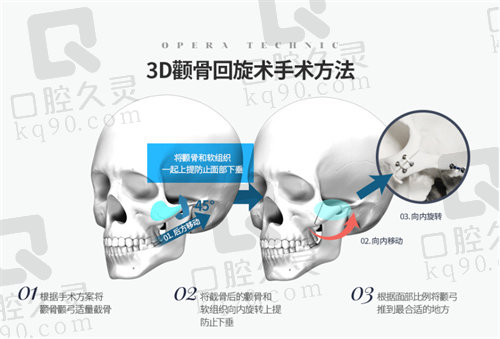 金锡汉院长颧骨内推