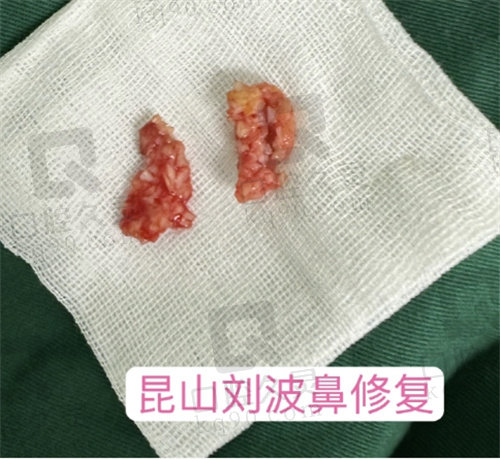 刘波医生鼻修复