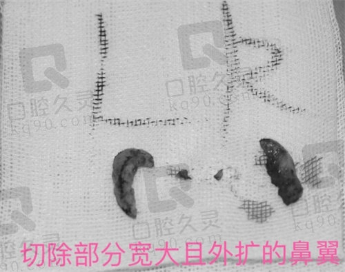 刘波医生做鼻子