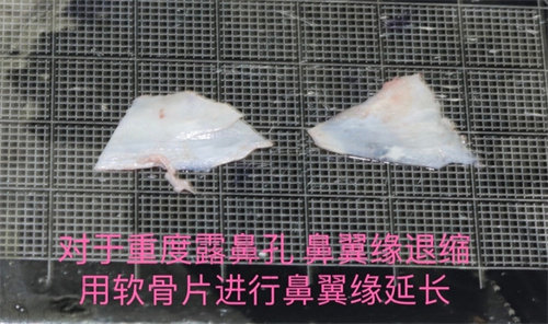 刘波医生做鼻子
