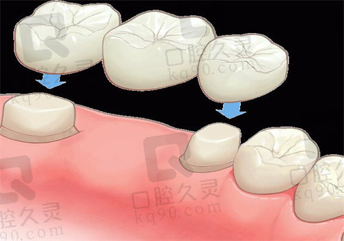 沈阳国颂口腔医院种牙结果是非常好的