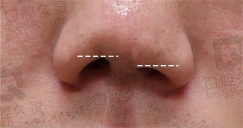 韩国noselips整形外科唇裂修复前