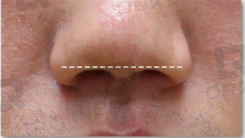 韩国noselips整形外科唇裂修复后