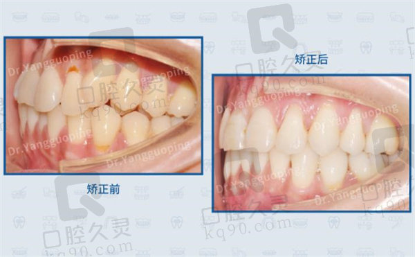 上海舌侧矫正杨国平医生实例