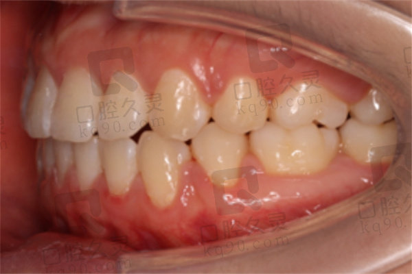 重庆泰康拜博口腔医院正畸后