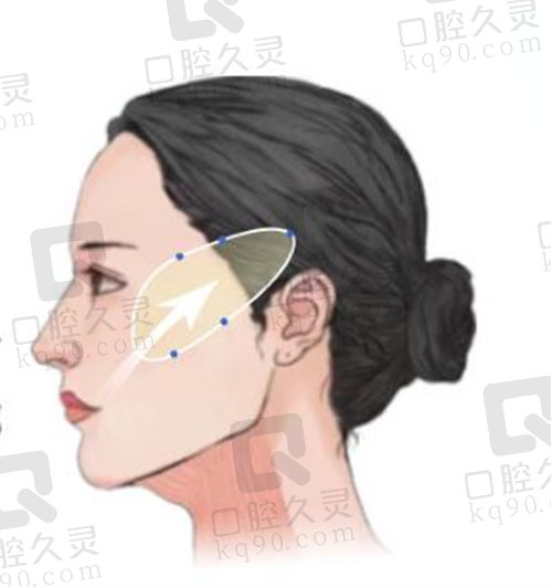 韩国歌柔飞金泰拉提升