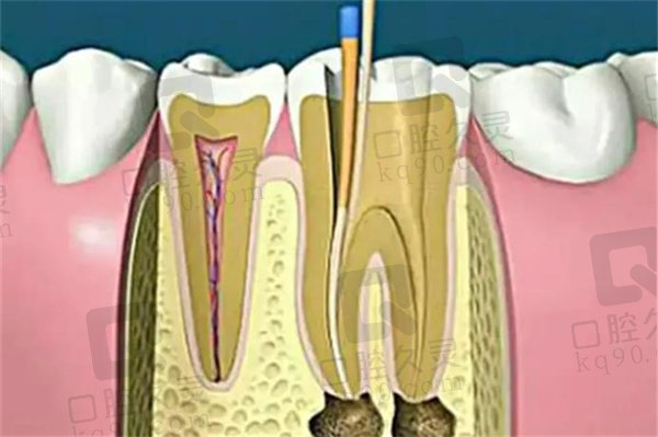 根管治疗