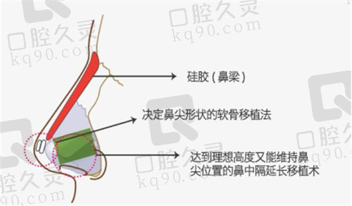 格瑞丝噢爱美鼻中隔延长