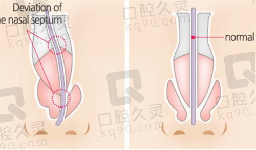 格瑞丝噢爱美歪鼻矫正