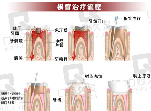 显微根管治疗术