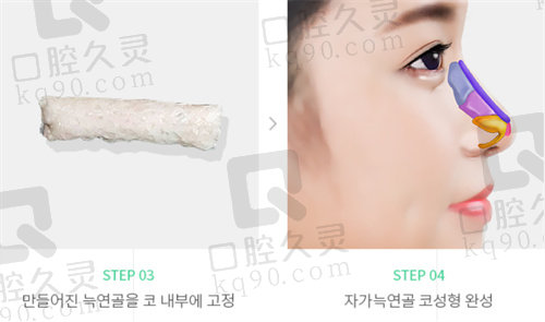 韩国优雅人整形外科肋软骨隆鼻