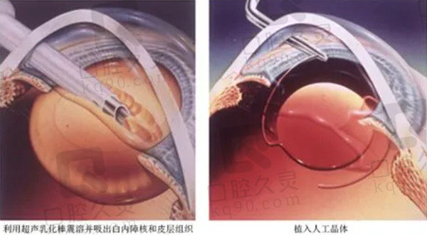 蔡迎晖医生做白内障手术示意图