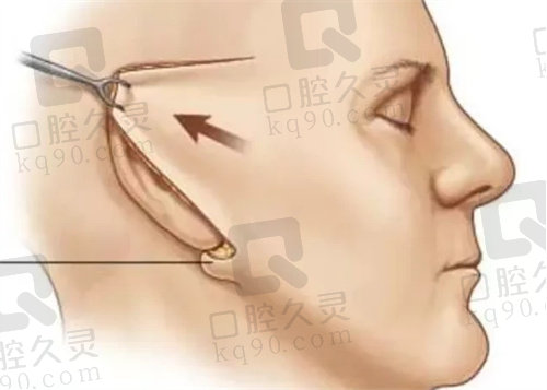 韩国必妩大拉皮手术拉皮切口