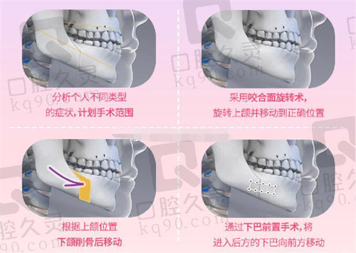 韩国必妩整形医院下巴手术