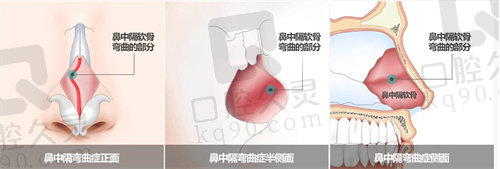 韩国GNG医院鼻中隔弯曲矫正