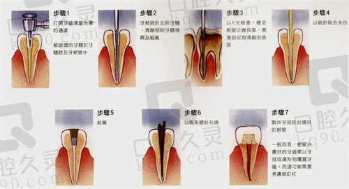 根管治疗后的牙齿又疼了怎么办