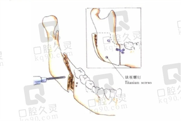 正颌手术