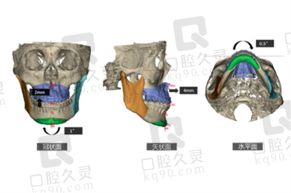 正颌手术设计