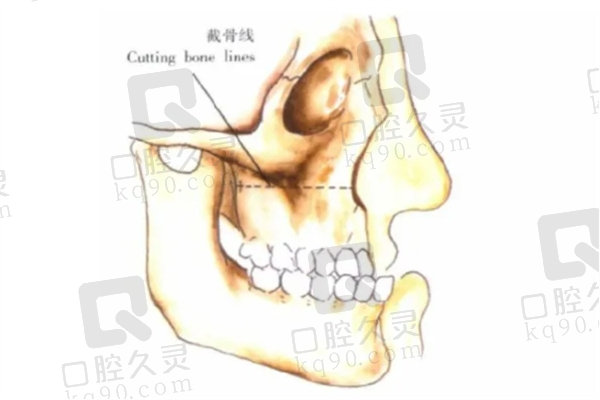 正颌手术