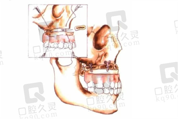 正颌手术