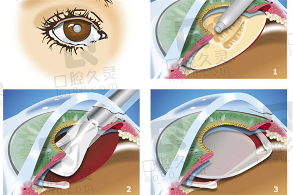 晶体置换手术过程