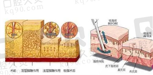 深圳八大处吸脂