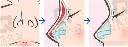 韩国TS整形肋软骨隆鼻