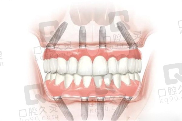 全口种植牙