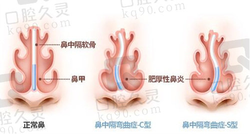 李奎昊修复鼻子