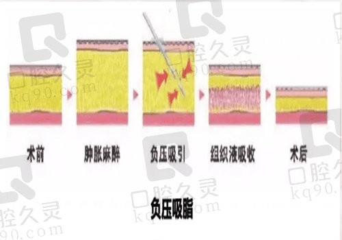 负压吸脂流程图