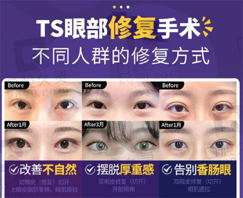 韩国TS整形眼修复类型