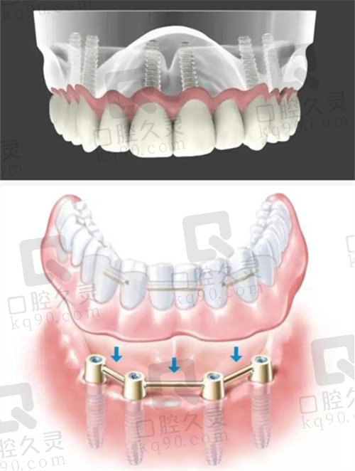 郑州中诺口腔医院袁雷医生即刻种植示意图