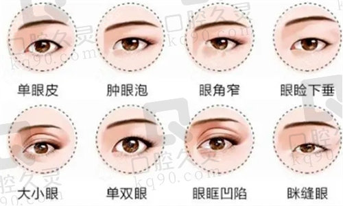 双眼皮修复类型