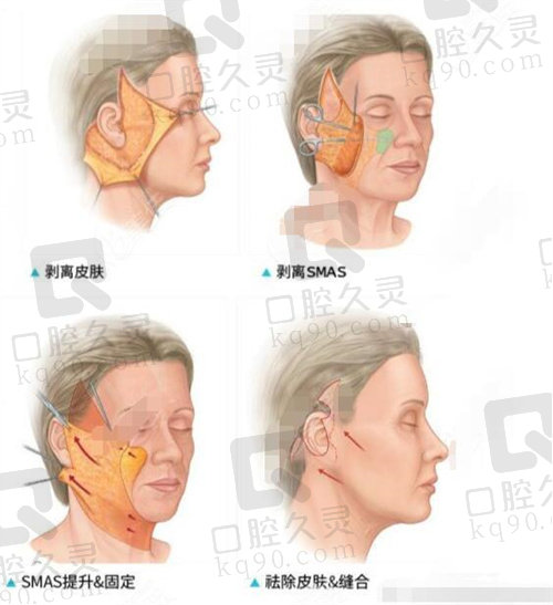 李晓东面部提拉剥离