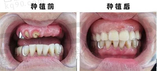 成都新桥口腔种植牙前后对比