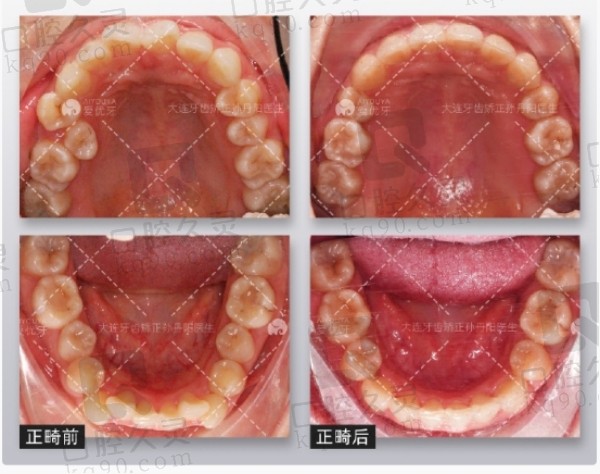 大连马泷齿科孙丹阳牙列拥挤矫正病例